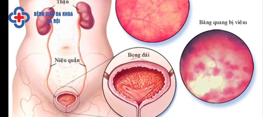 Viêm bàng quang là căn bệnh thường gặp ở nữ giới