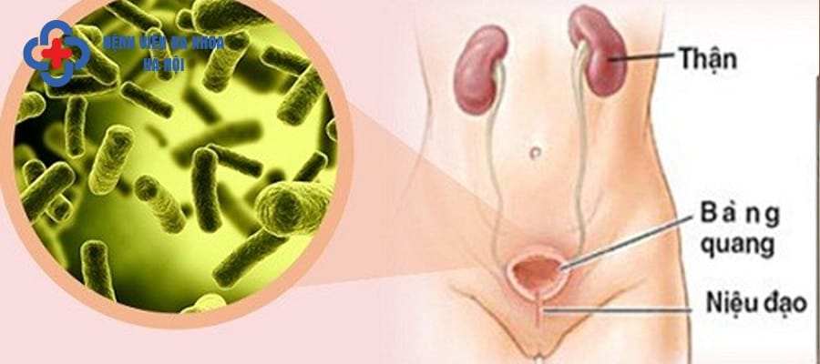 Viêm đường tiết niệu xảy ra khi bị vi khuẩn tấn công