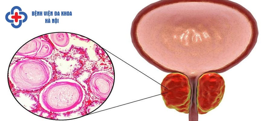 Viêm niệu đạo khiến người bệnh bị đau đớn