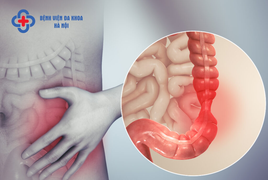 hội chứng ruột kích thích