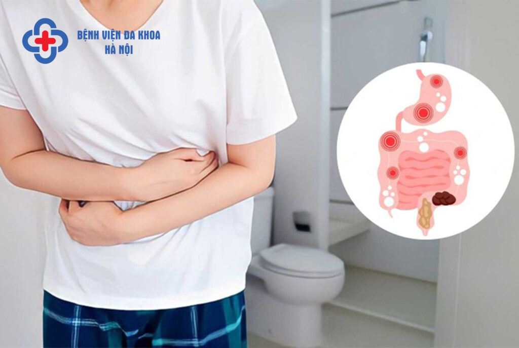 hội chứng ruột kích thích