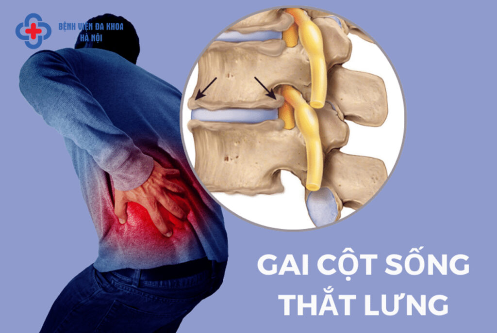 gai đốt sống