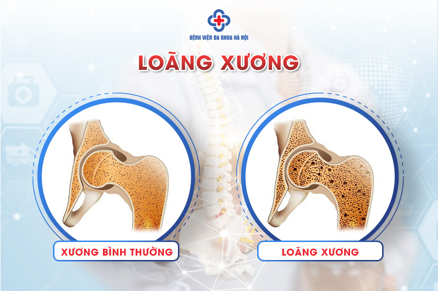 loãng xương ở độ tuổi nào?