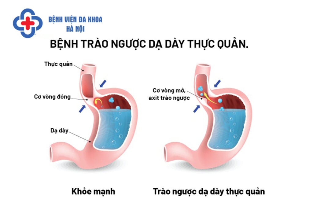 bệnh tiêu hóa