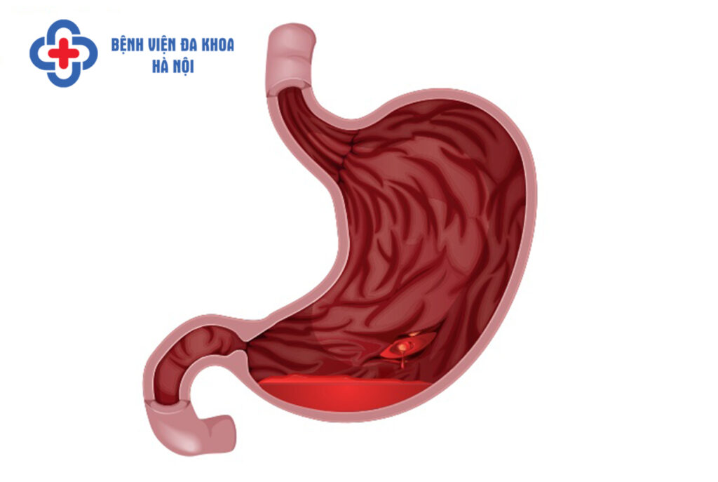 bệnh tiêu hóa
