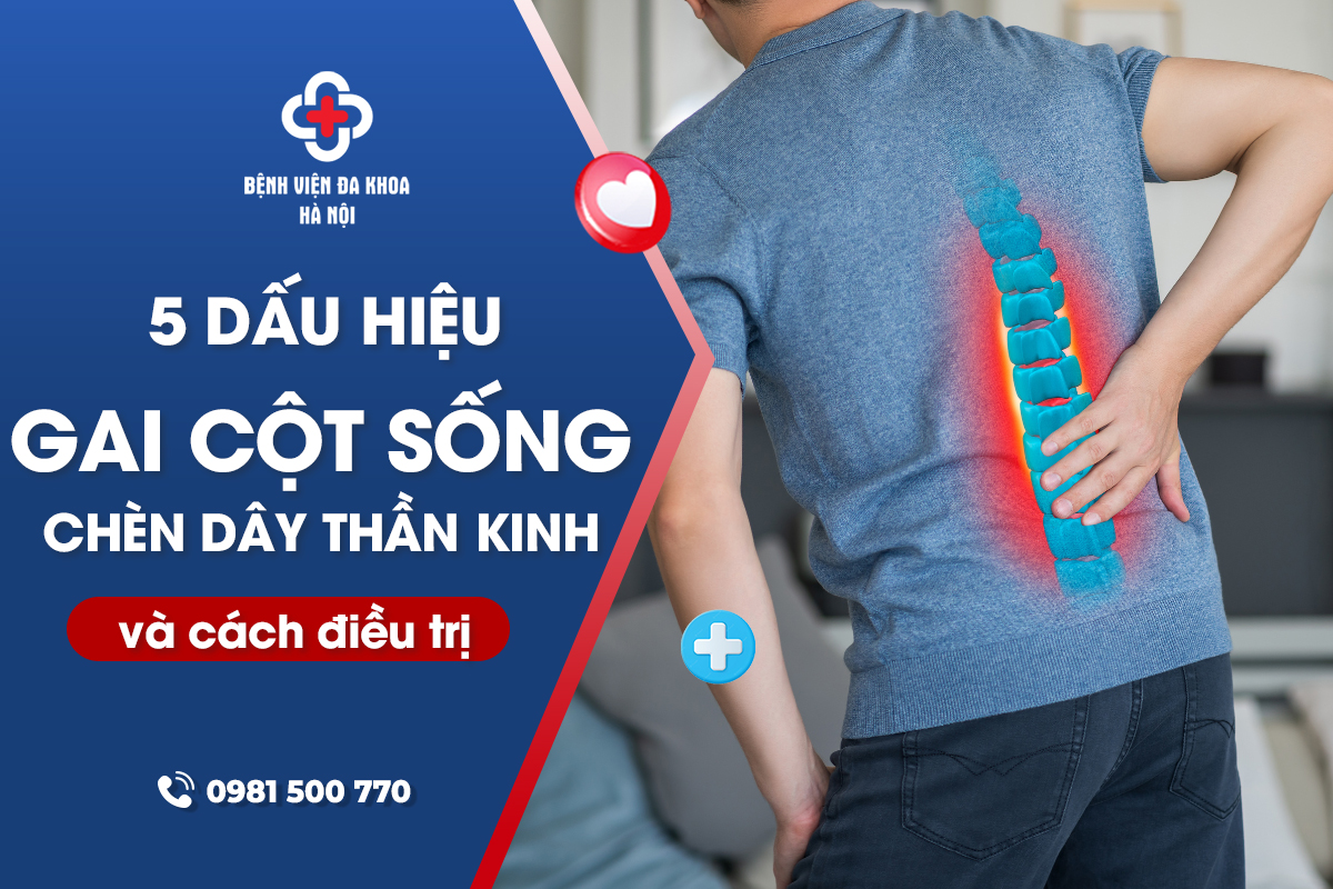 5 Dấu Hiệu Gai Cột Sống Chèn Dây Thần Kinh và Cách Điều Trị