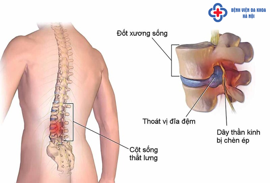đau rễ thần kinh