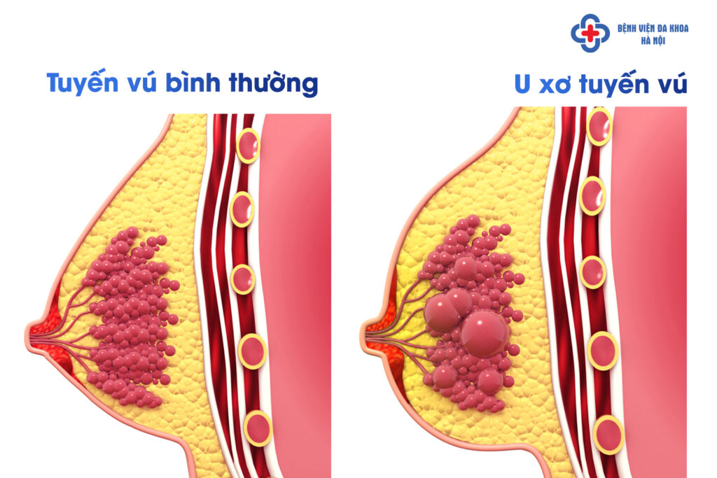 U xơ tuyến vú có khả năng tiến triển thành ung thư vú?