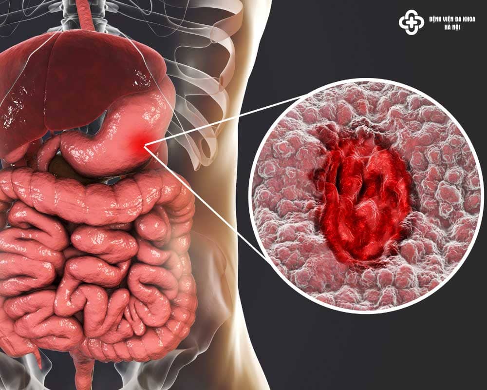 Dấu hiệu viêm loét đại tràng