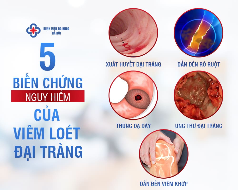 các biến chứng nghiêm trọng Viêm loét đại tràng
