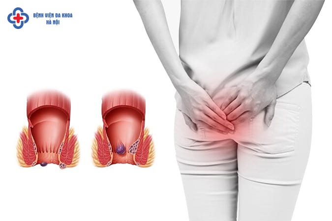 Bị trĩ không điều trị có nguy hiểm gì không?