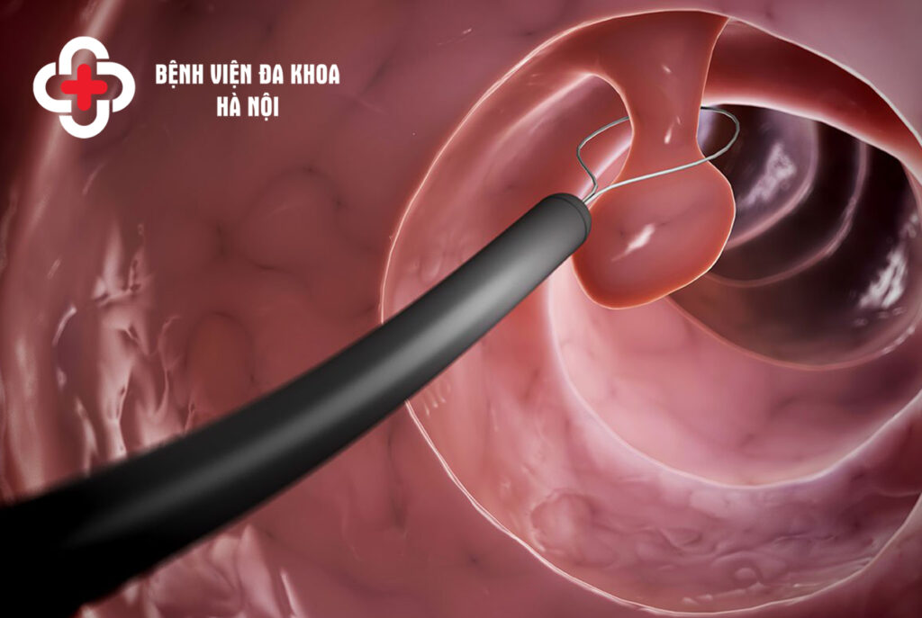 Phát hiện polyp đại tràng đều phải cắt bỏ? 