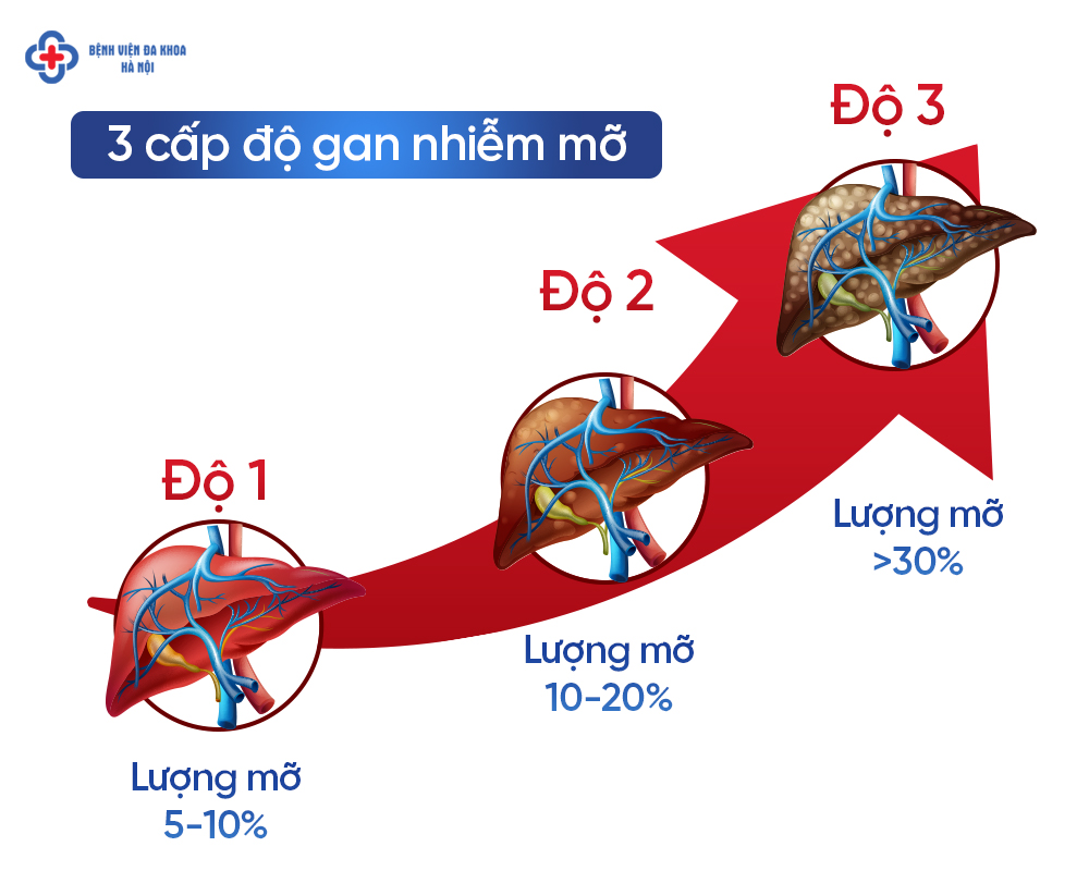 Phân loại gan nhiễm mỡ cấp 1, 2, 3