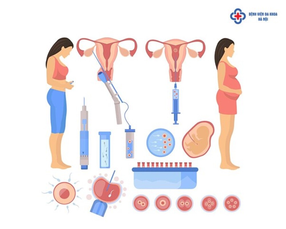 Bơm tinh trùng IUI là phương pháp hỗ trợ sinh sản phổ biến