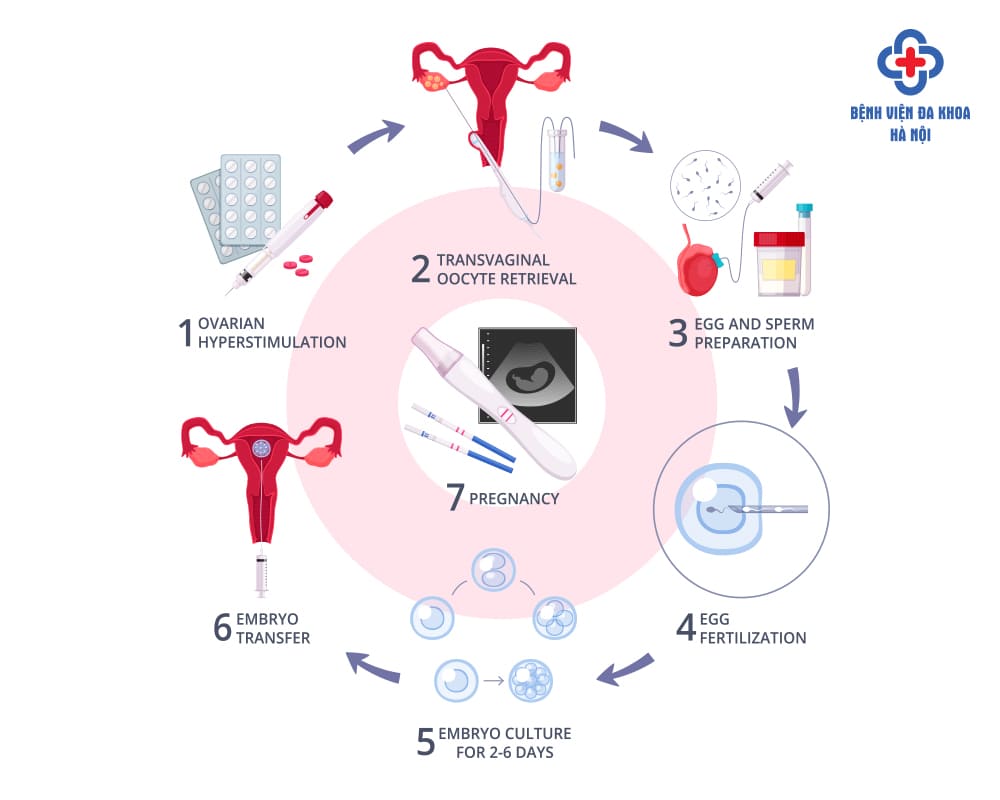 Các bước trong quy trình IVF