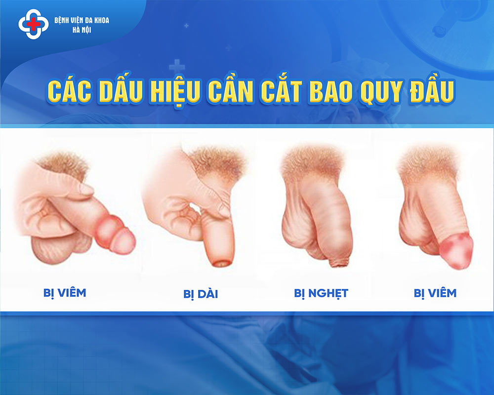 Các dấu hiệu cần cắt bao quy đầu