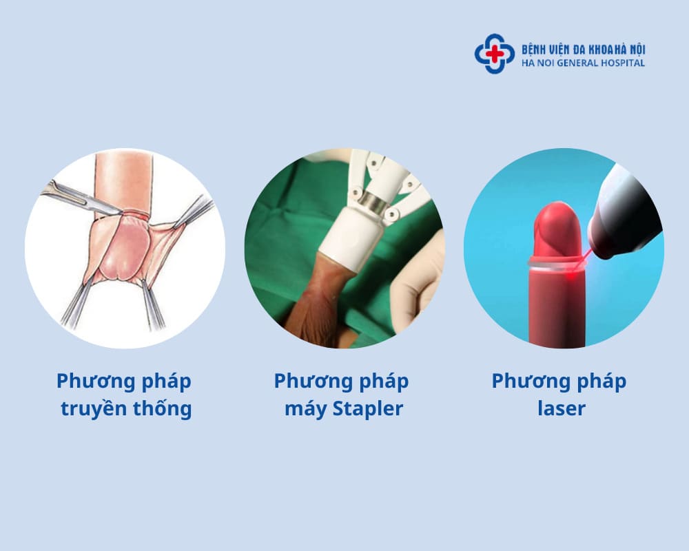 Các phương pháp cắt bao quy đầu