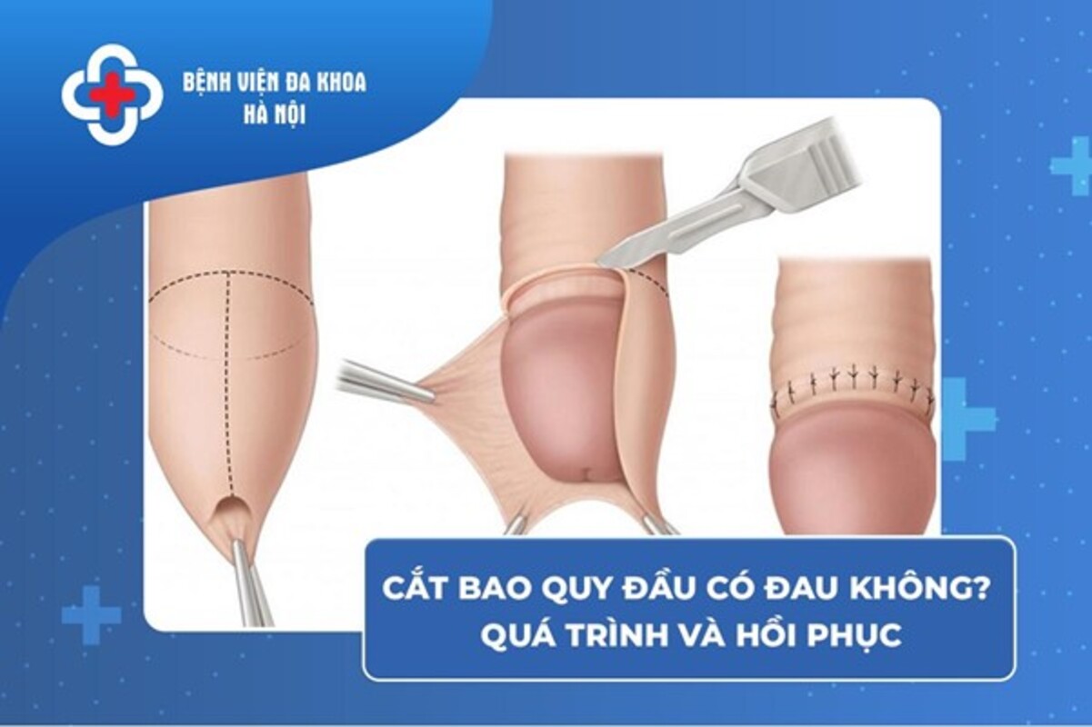 Cắt bao quy đầu có đau không_Sự thật về quá trình và hồi phục