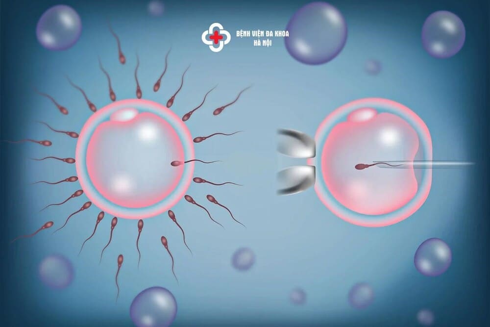 ICSI dần trở thành phương pháp hiệu quả cho các bà mẹ mong con lâu năm