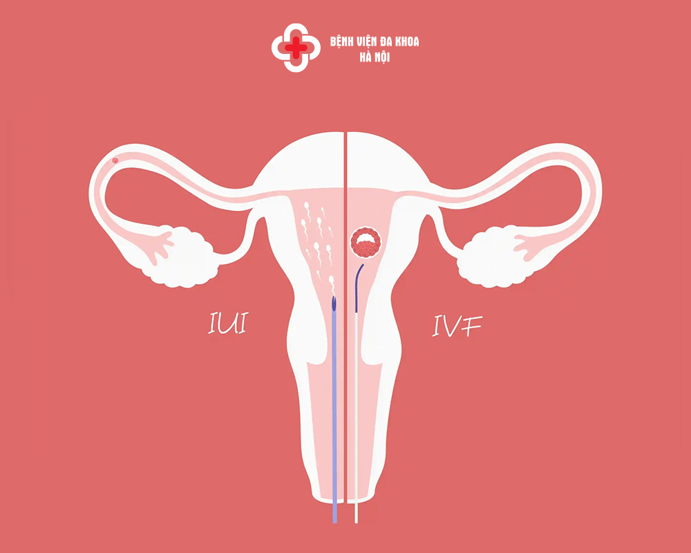 Độ tuổi can thiệp IUI và IVF đóng vai trò quan trọng đến tỷ lệ điều trị thành công