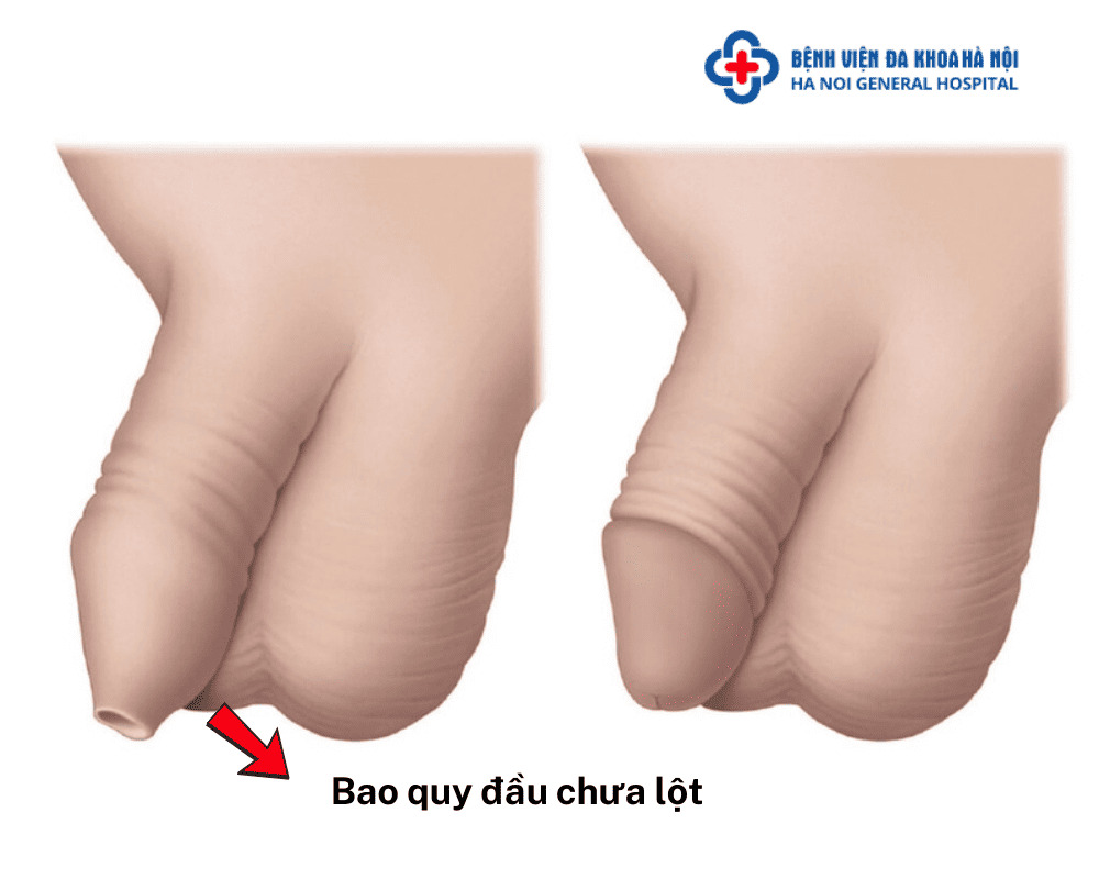 Như thế nào là bao quy đầu chưa lột