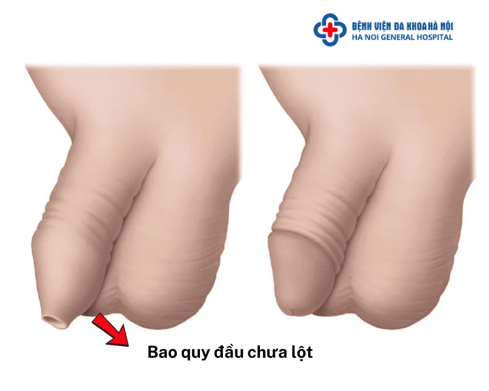 Như thế nào là bao quy đầu chưa lột