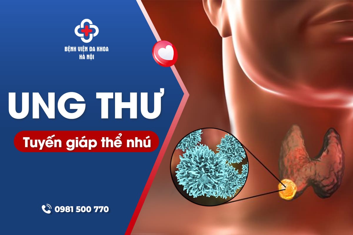Ung thư tuyến giáp thể nhú