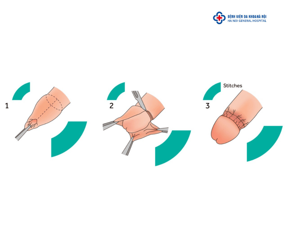 cắt bao quy đầu truyền thống