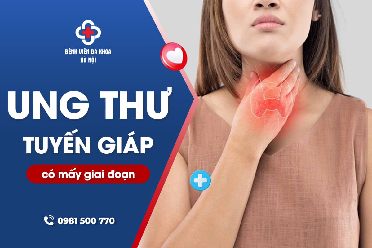 Ung thư tuyến giáp có mấy giai đoạn? Phân loại và hướng điều trị
