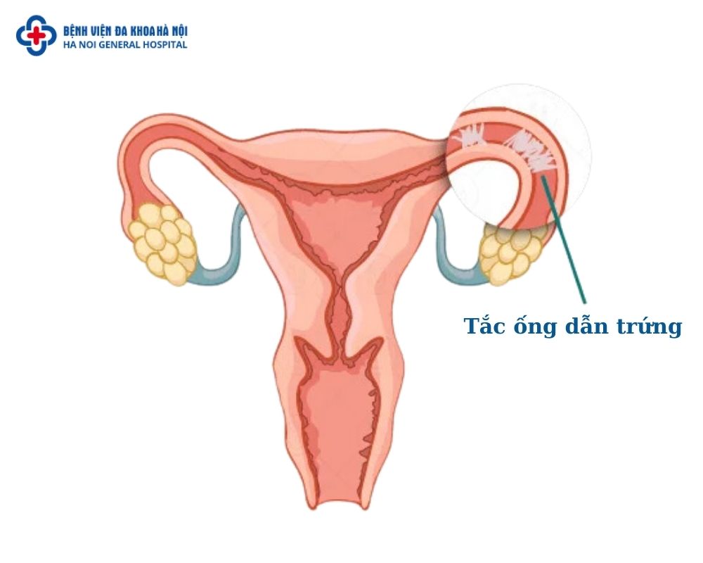 Tắc vòi trứng là gì?