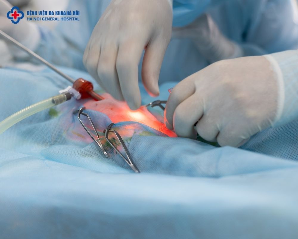 Phẫu thuật nội soi thông tắc ống dẫn trứng