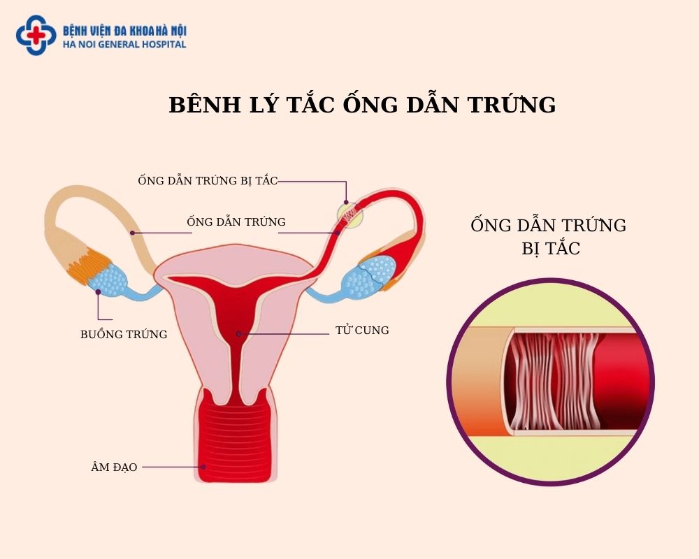 Nguyên nhân chính gây ra hiện tượng tắc vòi trứng