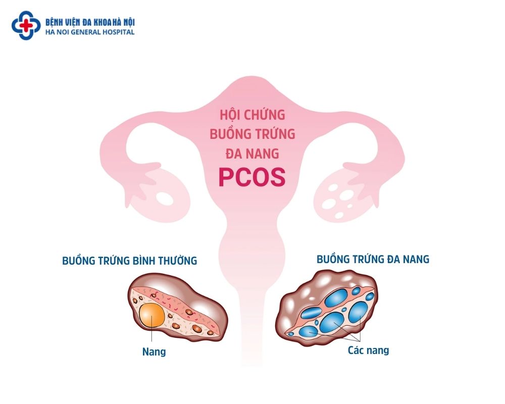 buống trứng bình thường vs PCOS