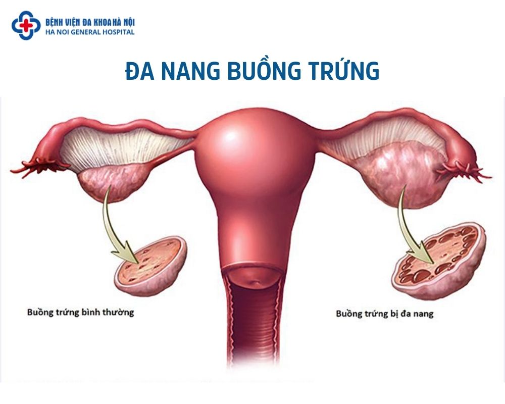 Đa nang buồng trứng là gì?