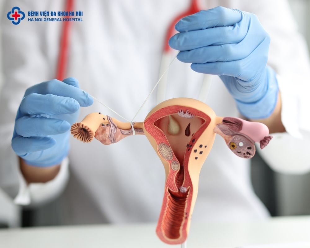 Viêm nhiễm vùng chậu (PID - Pelvic Inflammatory Disease)