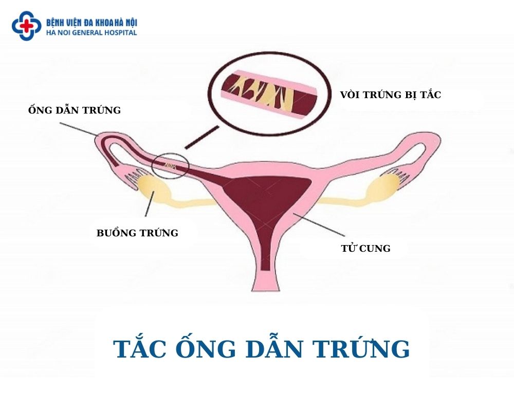 Tắc vòi trứng nguyên nhân phổ biến gây vô sinh