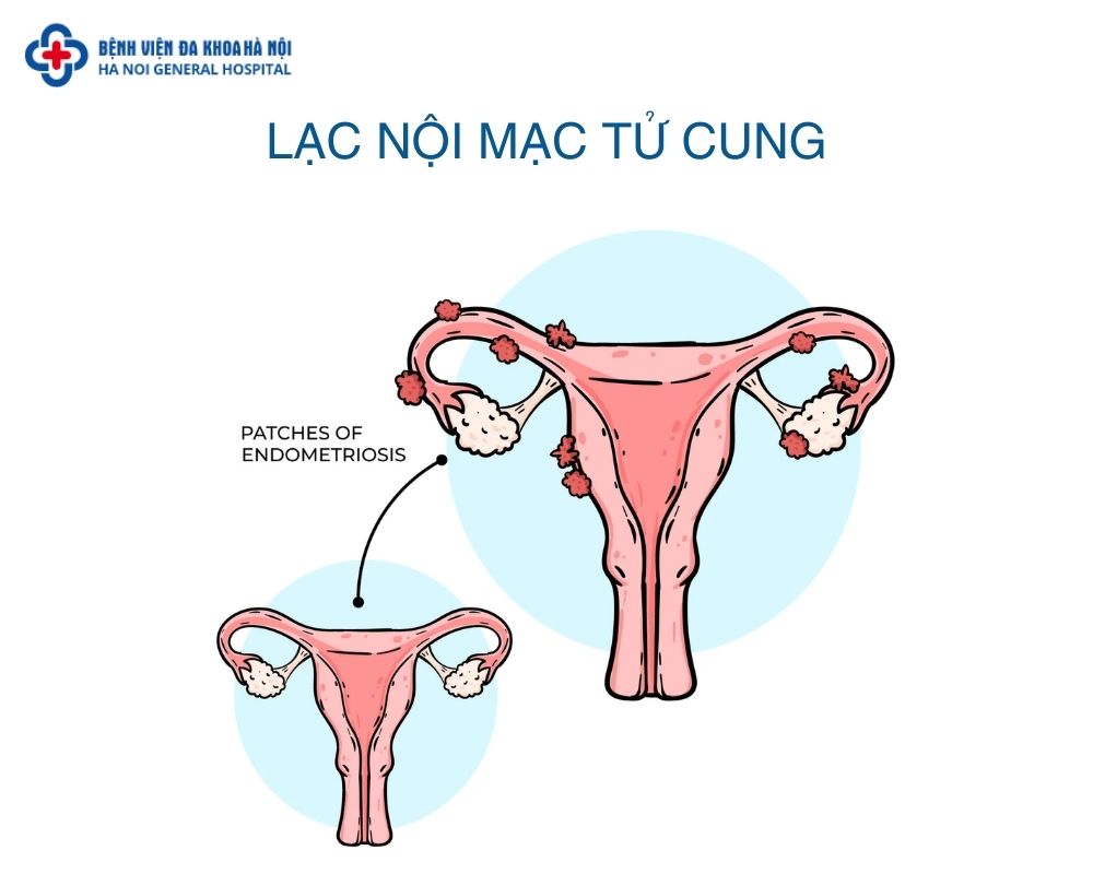 Lạc nội mạc tử cung là gì?