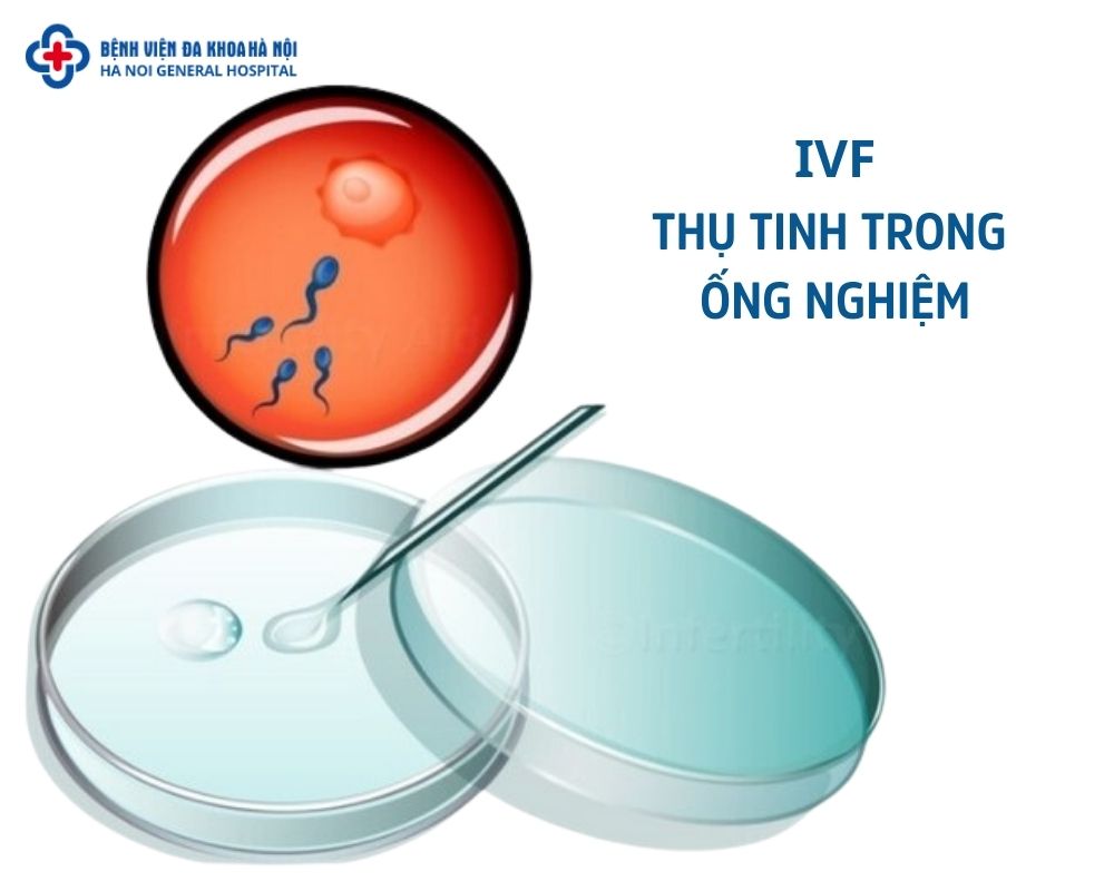 ivf- thụ tinh trong ống nghiệm