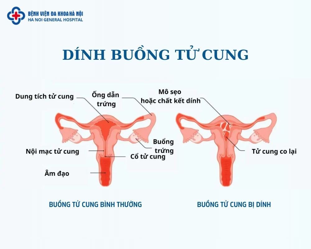 Dính buồng tử cung là gì?
