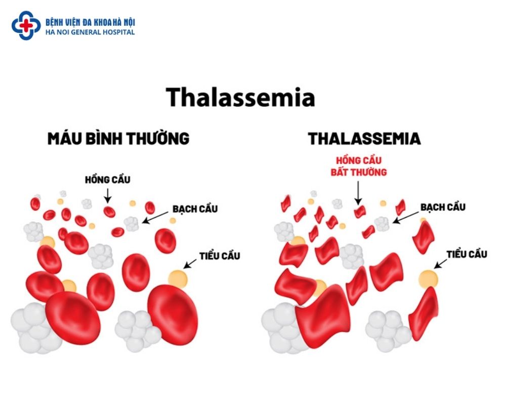 Đột biến dị hợp tử SEA có thể dẫn đến bệnh thalassemia