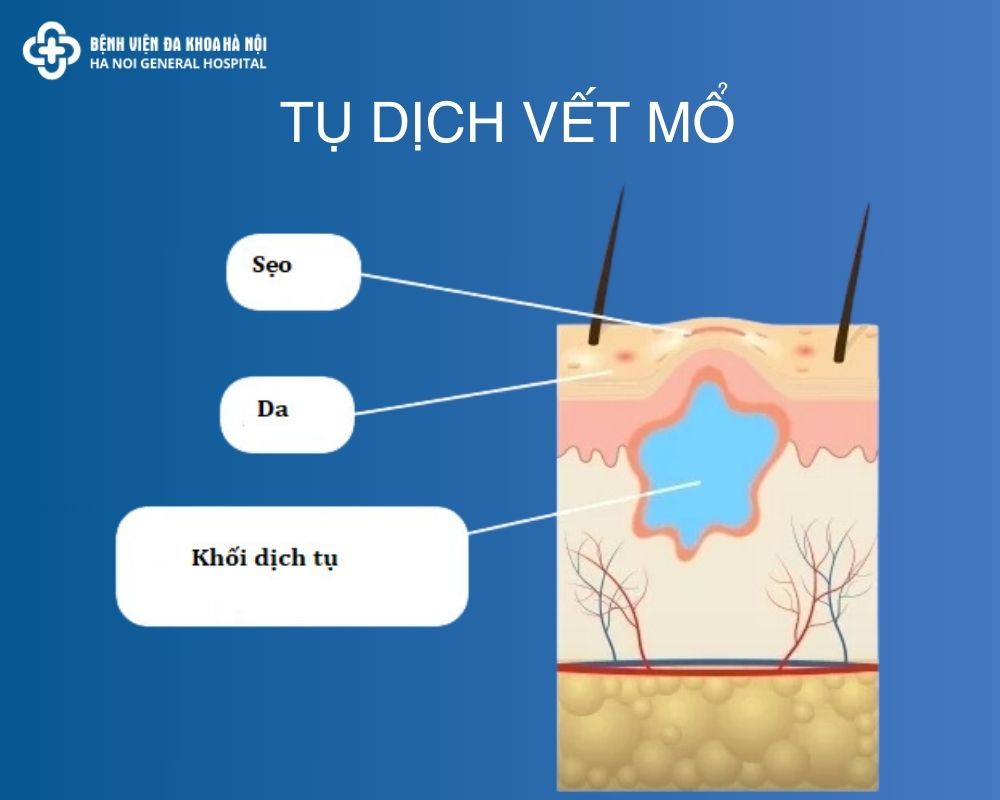 Tụ dịch vết mổ là gì?