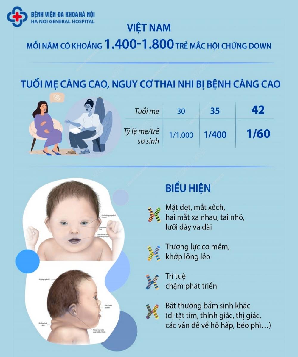 Hội chứng Down (Trisomy 21)