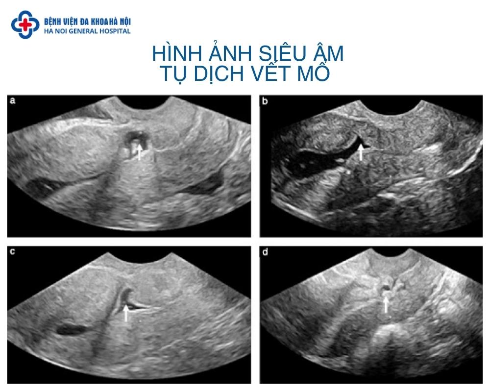 Siêu âm tụ dịch vết mổ
