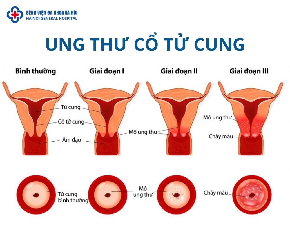 Ung thư cổ tử cung là gì?