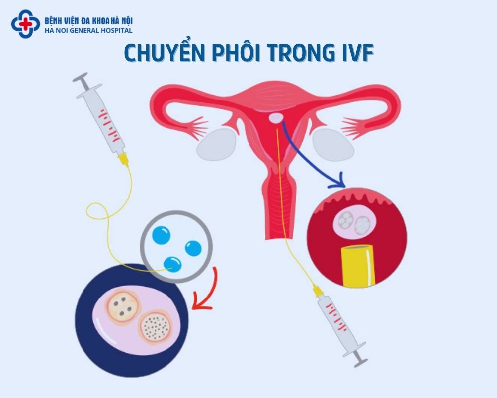 Quy trình chuyển phôi IVF