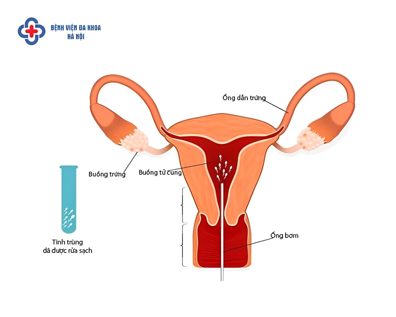 Bơm IUI - Phương pháp điều trị hiếm muộn phổ biến
