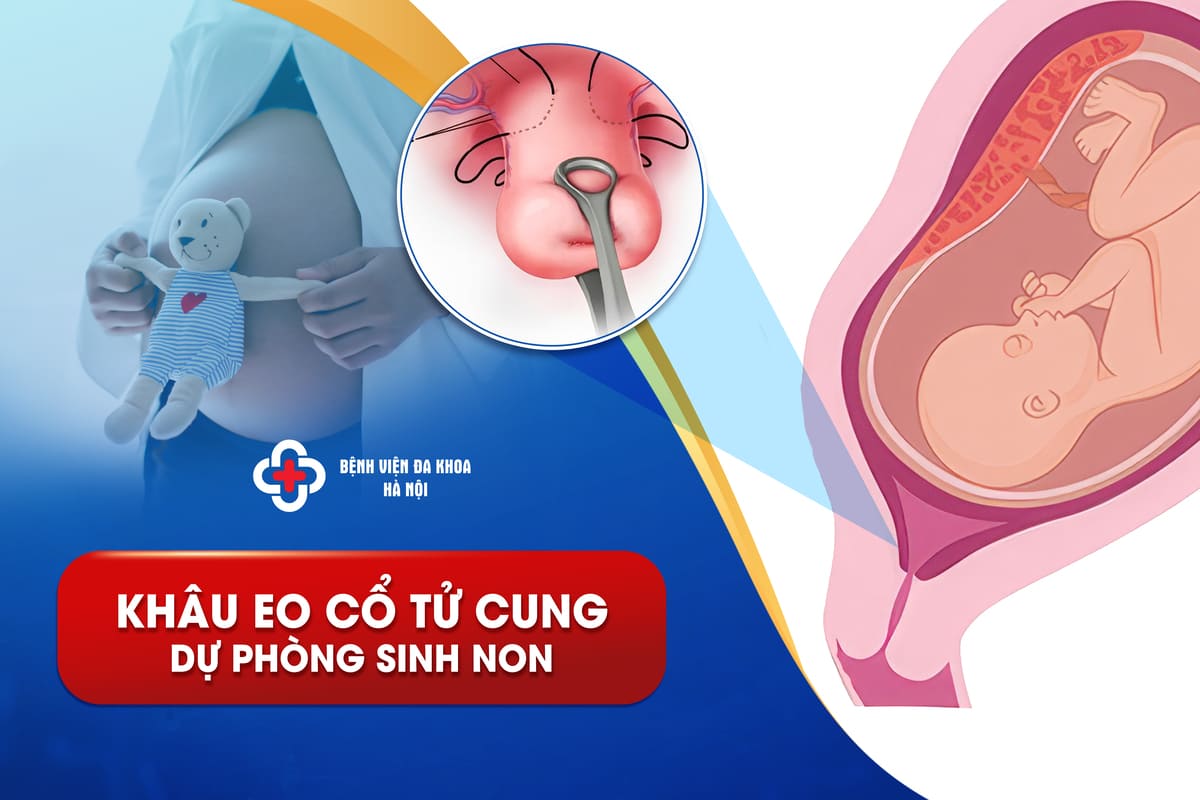 Khâu eo cổ tử cung dự phòng sinh non - Bệnh viện Đa khoa Hà Nội